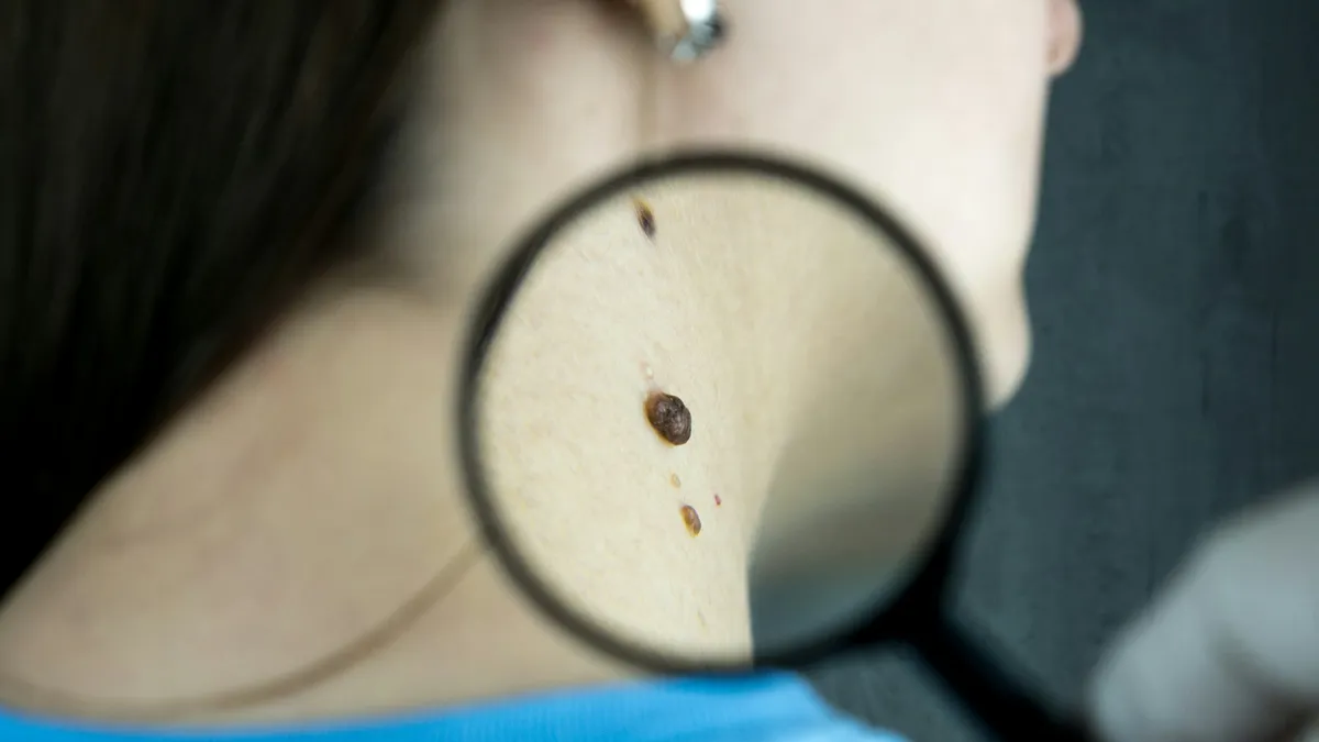 Dermatoloog onderzoekt de huid van een patiënt met een dermatoscoop tijdens een huidonderzoek